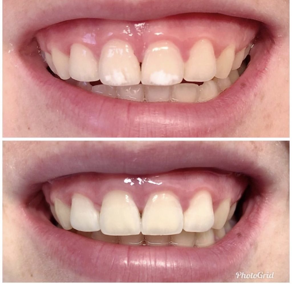 teeth with white spots and teeth with no white spots